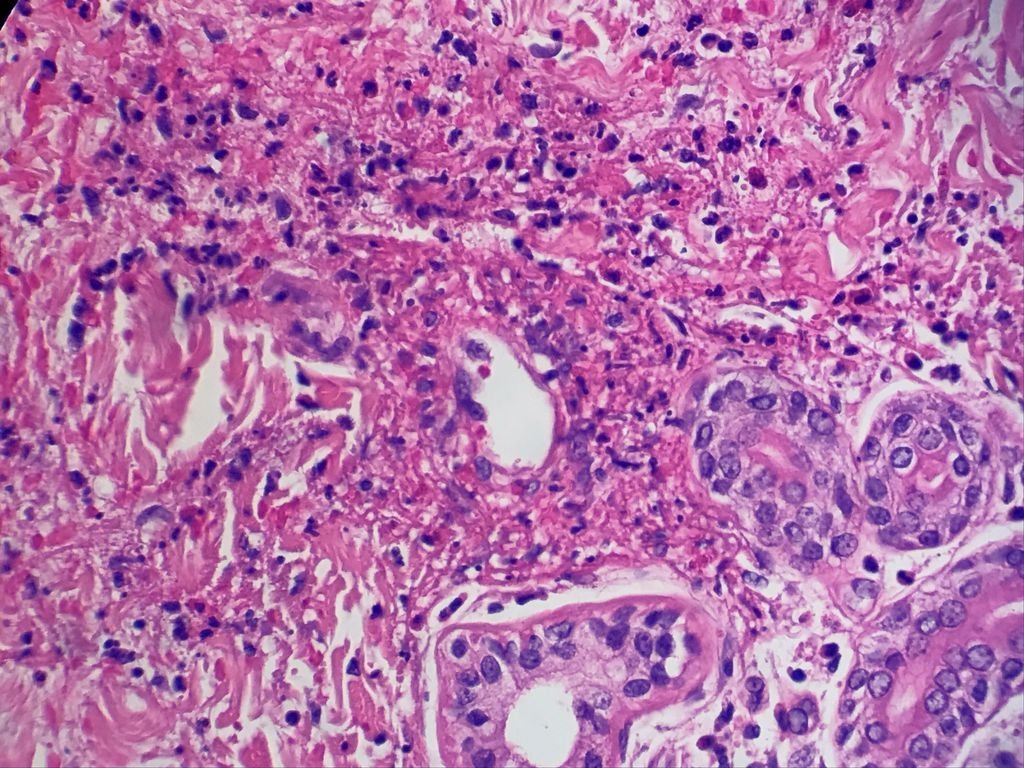 DermpathMGH (@dermpathmgh) on Twitter photo eosinophils in vascular wall w/damage: Churg-Strauss Syndrome/Allergic granulomatosis with angitis. Rare disorder with feat. of asthma,fever&multisystem vasculitis,extravascular granulomata &hypereosinophilia. #Dermpath365 #Dermpath <a href="/DrPatrickRush/">Patrick Rush</a> <a href="/RosNazarianMD/">Rosalynn Nazarian MD</a> <a href="/LynDuncanMD/">LMD</a> eosinophils in vascular wall w/damage: Churg-Strauss Syndrome/Allergic granulomatosis with angitis. Rare disorder with feat. of asthma,fever&multisystem vasculitis,extravascular granulomata &hypereosinophilia. #Dermpath365 #Dermpath <a href="/DrPatrickRush/">Patrick Rush</a> <a href="/RosNazarianMD/">Rosalynn Nazarian MD</a> <a href="/LynDuncanMD/">LMD</a>