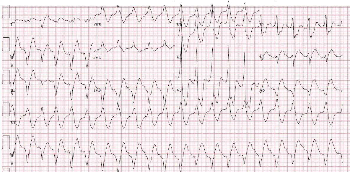 Stephen W Smith Posterolateral Omi Resulting In Vt Then R On T Phenomenon And Vf T Co 8vfusgumki