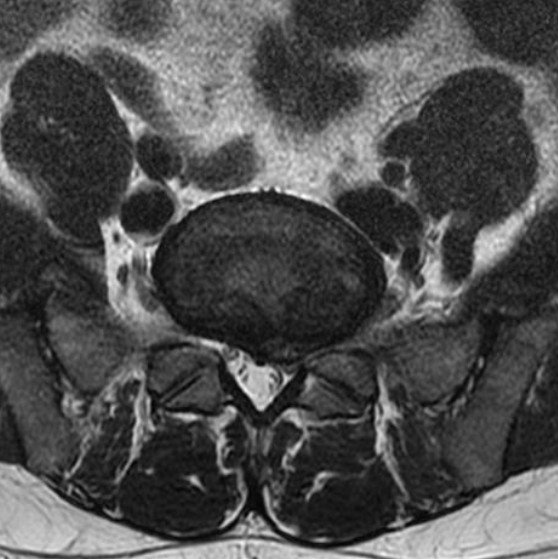 TimLuijkx's tweet photo. Think about those descending nerve roots being compressed in the subarticular recess when the exiting nerve root is fine @Radiopaedia @DrAndrewDixon #RadReview https://t.co/aGzD4mb6sq