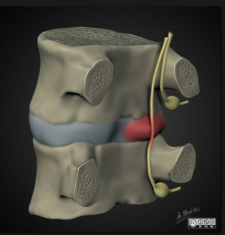 TimLuijkx's tweet photo. Think about those descending nerve roots being compressed in the subarticular recess when the exiting nerve root is fine @Radiopaedia @DrAndrewDixon #RadReview https://t.co/aGzD4mb6sq