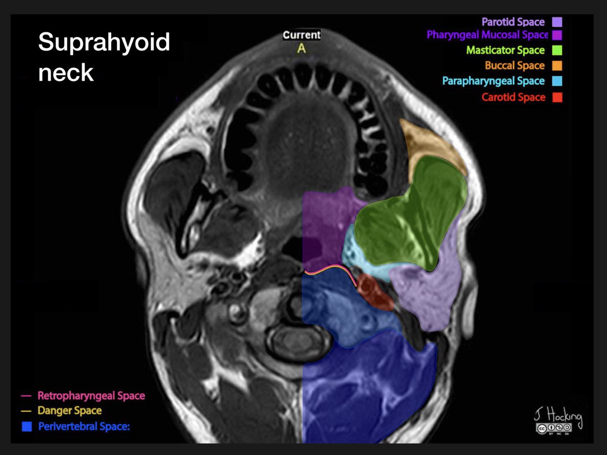 Suprahyoid neck Skull anatomy, Anatomy, Radiology