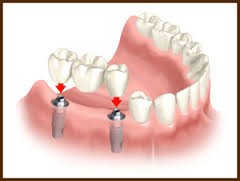 arrowheadpros's tweet photo. Never say never to dental care visit: The expert Prosthodontist in Phoenix, AZ at Arrowhead dental clinic offers the top advice to patients suffering from various dental issues. https://t.co/U6OSrazuMv