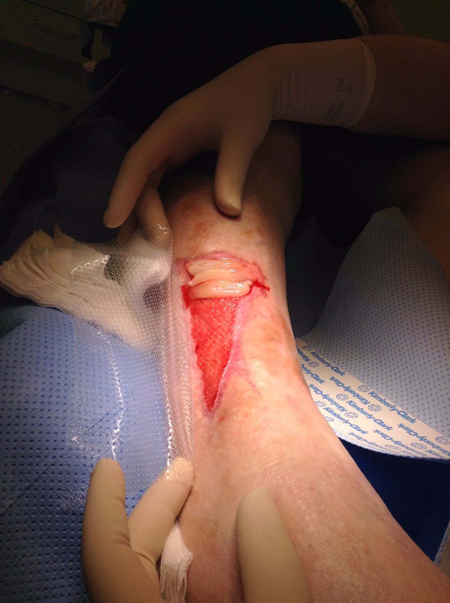 Wondzorgcentrum's tweet photo. @vrtnws Eerste cases beschikbaar via #wondzorgcentrum https://t.co/yIQJJYqwZj