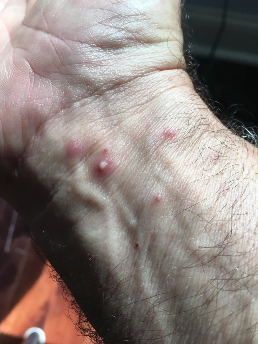 suelos2010's tweet photo. Fire ants at Calhoun finally overwhelmed DanR at the Calzone this week. #czo #cczo https://t.co/fuH96Qn1iR