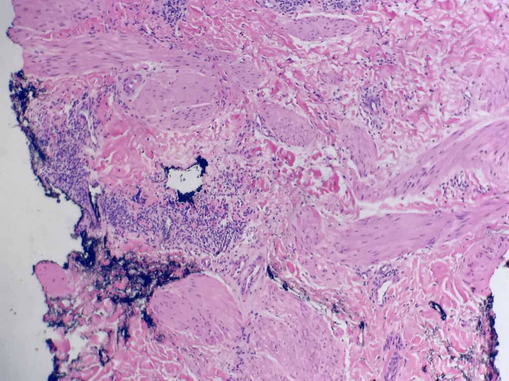 Nipple eczema #Dermpath365 #dermpath