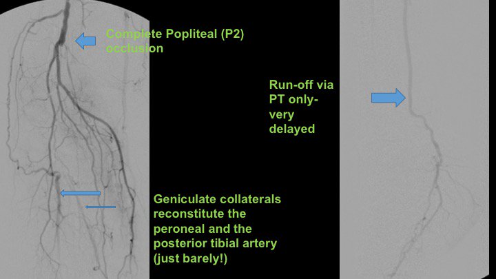 Watts_IR's tweet image. Active R4 patient limited at her full time job, losing sleep at night. Motivated to fight through pain, but needs help.  Amazed at how well she functioned like this.  She'll do awesome now! Shout out to @keithppereira for the support during the case! #CLIFighters #MyLegMyLife