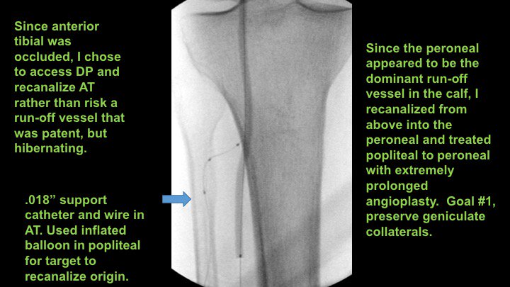 Watts_IR's tweet image. Active R4 patient limited at her full time job, losing sleep at night. Motivated to fight through pain, but needs help.  Amazed at how well she functioned like this.  She'll do awesome now! Shout out to @keithppereira for the support during the case! #CLIFighters #MyLegMyLife