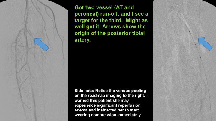 Watts_IR's tweet image. Active R4 patient limited at her full time job, losing sleep at night. Motivated to fight through pain, but needs help.  Amazed at how well she functioned like this.  She'll do awesome now! Shout out to @keithppereira for the support during the case! #CLIFighters #MyLegMyLife