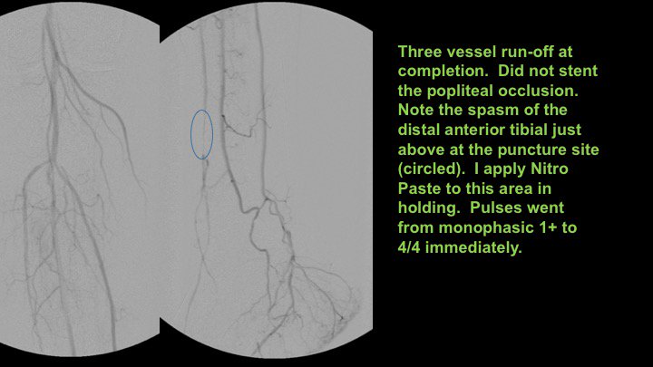 Watts_IR's tweet image. Active R4 patient limited at her full time job, losing sleep at night. Motivated to fight through pain, but needs help.  Amazed at how well she functioned like this.  She'll do awesome now! Shout out to @keithppereira for the support during the case! #CLIFighters #MyLegMyLife