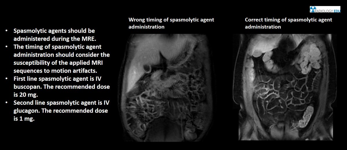 RadiologyEDU's tweet photo. Information about the timing of spasmolytic agent administration during the MRE!
More info here: https://t.co/5LQpZBBCSm
#radiologyedu #myradiologyedu #radiologyeducation #myradiologyeducation #radiology #MRI #MRE #enterography #smallbowel #Radiographer #radtech #MRI_Technologist https://t.co/QG5EafzmJH