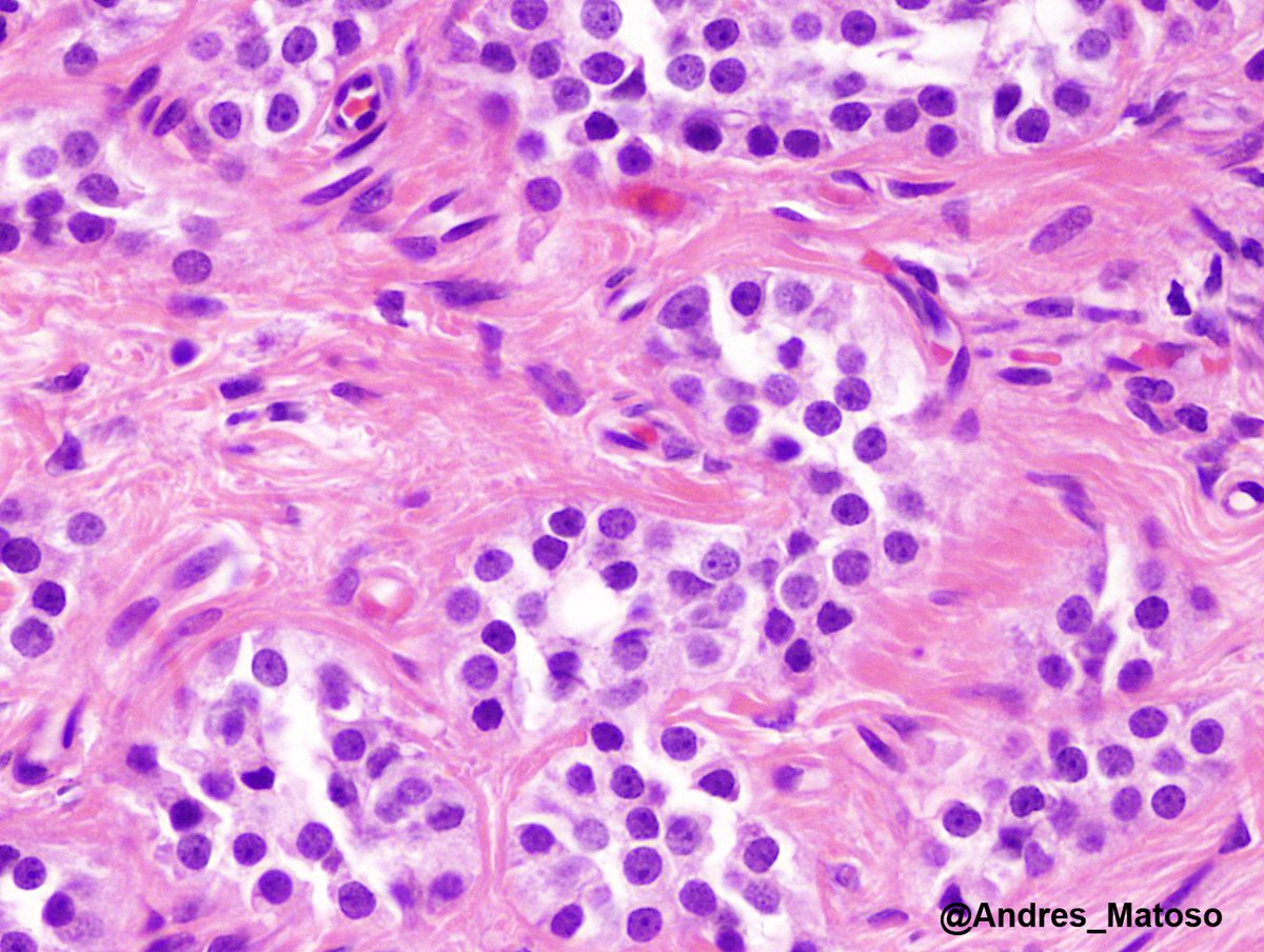 Well circumscribed with discrete cords and nests of tumor cells among heavily hyalinized or sclerosed stroma is characteristic of Sertoli cell tumor. >5cm, atypia, mitoses, necrosis, LVI, infiltrative are assoc with recurrence. Inhibin can be negative. #GUpath #urology