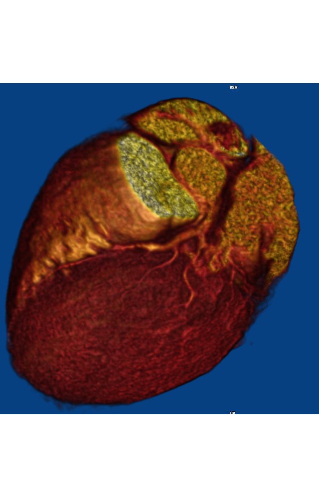 Winstonj19's tweet photo. #FOAMed #FOAMrad #cardiotc #radiology #globalrad #resrad https://t.co/AcAEuI1Seo