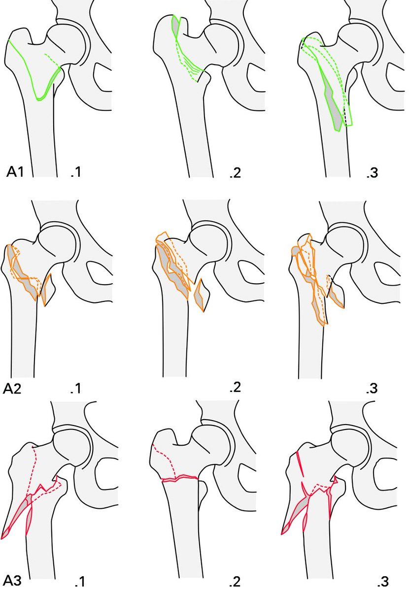 Stable, unstable &amp; subtrochanteric intertrochanteric #fractures vary widely in their #anatomical &amp; #biomechanical characteristics; <a href="/YaleMed/">Yale School of Medicine</a> surgeons advocate #fixation of 31A1 fractures with a sliding #hip screw &amp; all others with an intramedullary device ow.ly/JHGu30lK3um