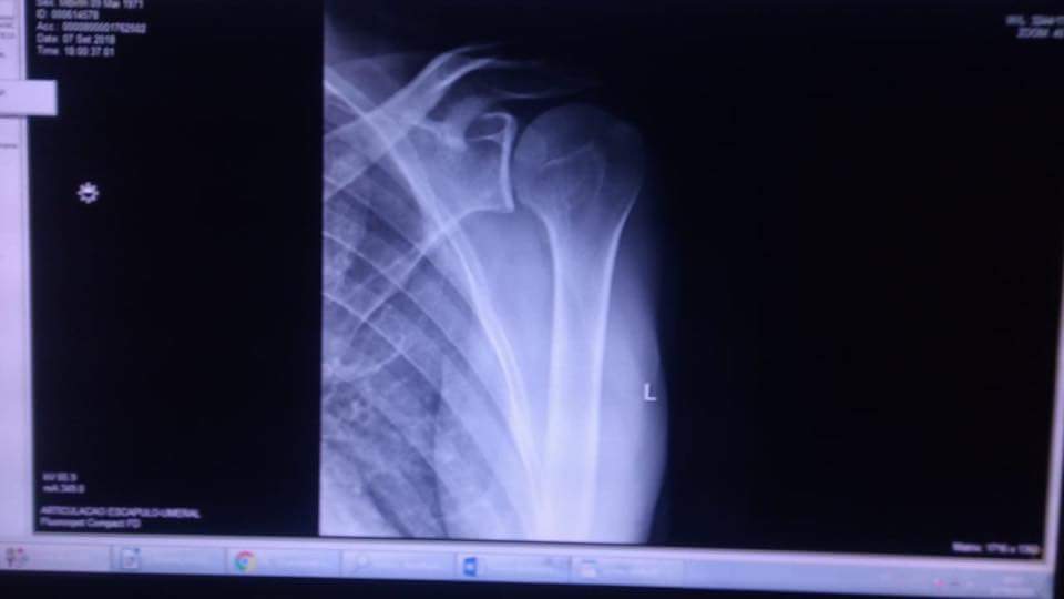 AntoineCousot's tweet photo. Bilan médical sans appel pour mon épaule avec des ligaments en vrac et lésions hill-Sachs. Retour à l’hôpital mardi pour un IRM. J’en ai pour 6 mois à soigner tout ça correctement!
Merci encore à mes amis brésiliens et français qui me remontent le moral. #goldengloberace https://t.co/iso25p9Jhx