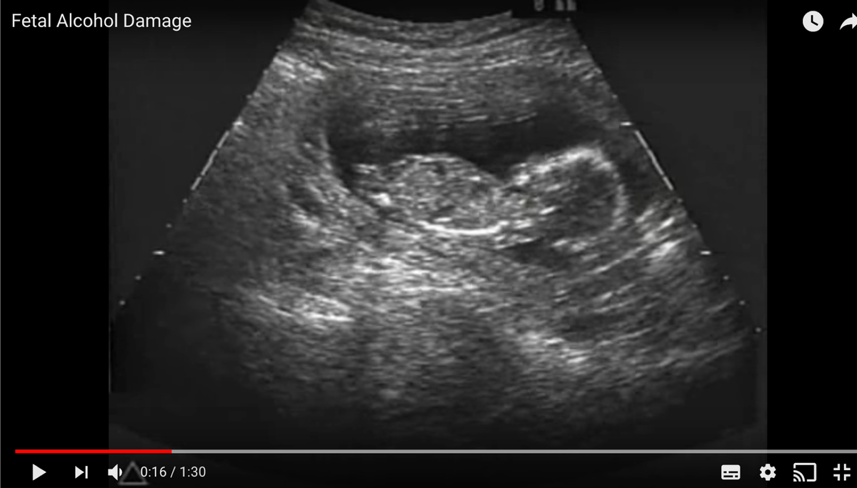 mktsociale's tweet photo. Fetal Alcohol Damage - #TYTD2018 #fasd #FASDay2018 #zeroalcoholinpregnancy @DTaruscio @jobuckard @HaltonCas @brewtiful_tea @bluecrosskisumu @CourtneyTownsel @oursacredbreath @DrKMcLachlan @Bevhillsyeg  https://t.co/vOAnJ2q2QK https://t.co/rgYkGrQYHl