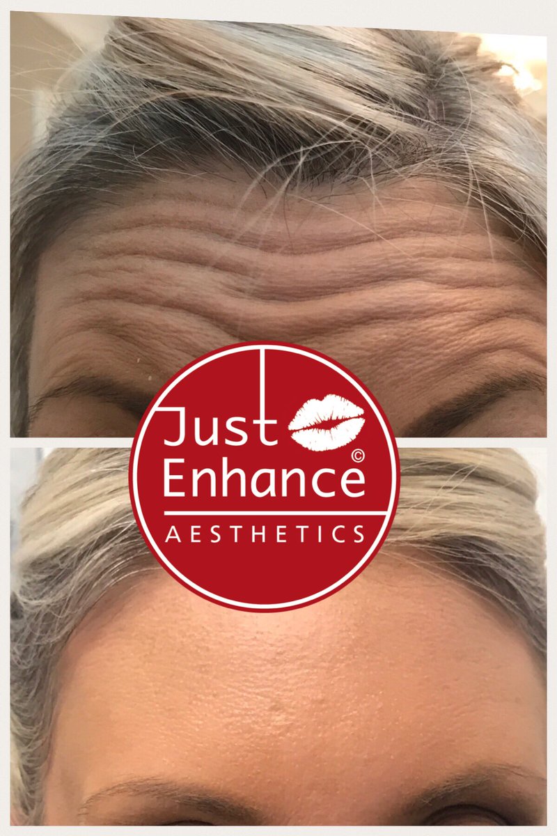 JustEnhance's tweet photo. Fantastic results 👌🏼 picture perfect ❤️

 #antiaging #maletreatments #brotox #scrotox #wrinklefree #nomorelines #allergan #azzalure #bocuture #babybotox #linerelaxing #wrinklerelaxing #lovetheskinyourin #tweakments https://t.co/ikrt903Cqm