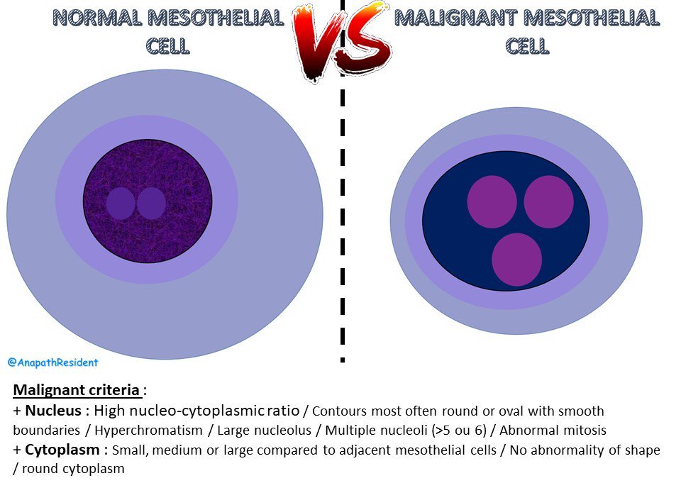 A_Morini_MD's tweet image. Mesothelial cell : tips and tricks for cytology of effusions.
#cytopath #PathBoards