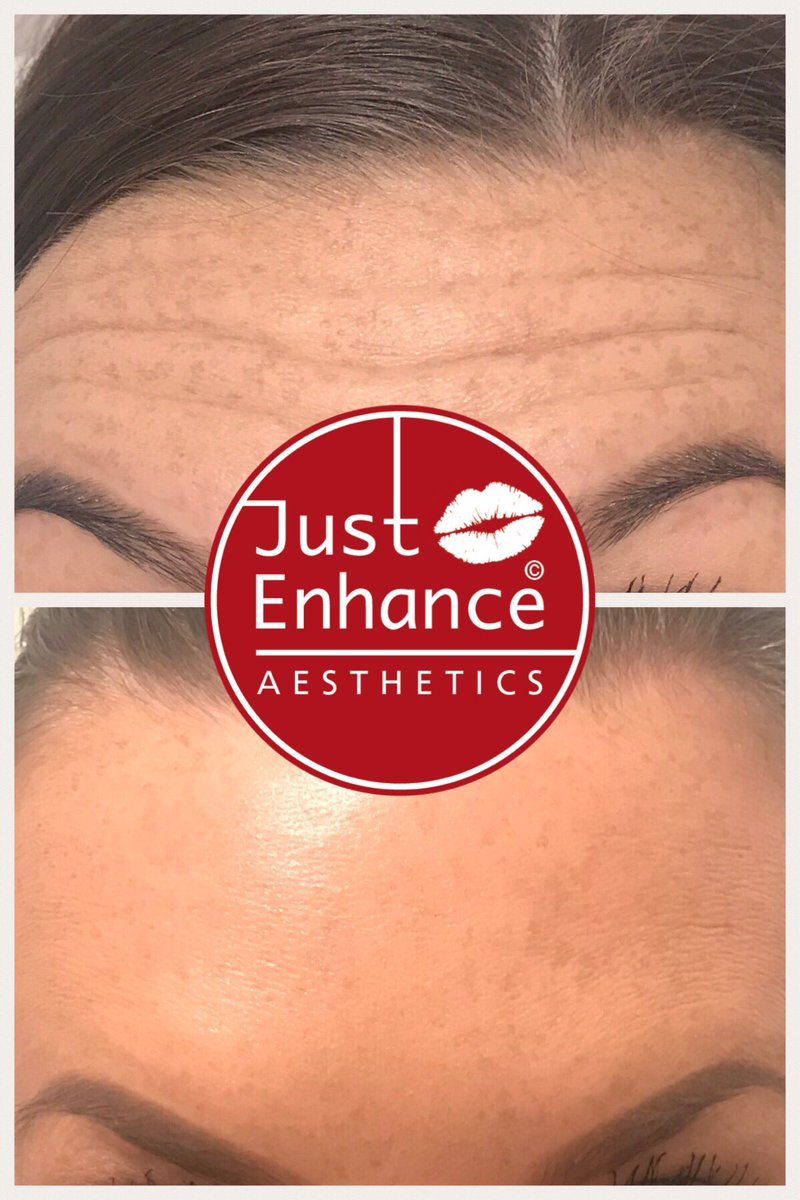 JustEnhance's tweet photo. Amazing fresh looking skin, contact us for a consultation now!
 #antiaging #maletreatments #brotox #scrotox #wrinklefree #nomorelines #allergan #azzalure #bocuture #babybotox #linerelaxing #wrinklerelaxing #lovetheskinyourin #tweakments https://t.co/wY7YFVnh5W