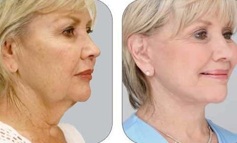 Biological Facelifts And Face Yoga Exercises goo.gl/lWDvf