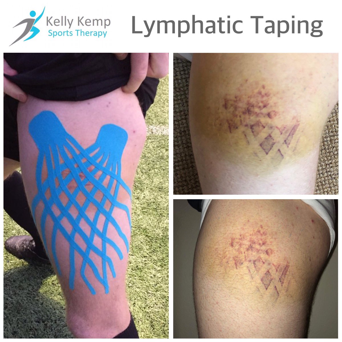 A footballer fell onto his hip & developed this large bruise. These were the results after I applied a lymphatic k-tape method! Regardless of inconclusive research, this shows k-tape can have physiological effects!
#kinesiologytape #ktape #injury #lymphatic #sportstape #kttape