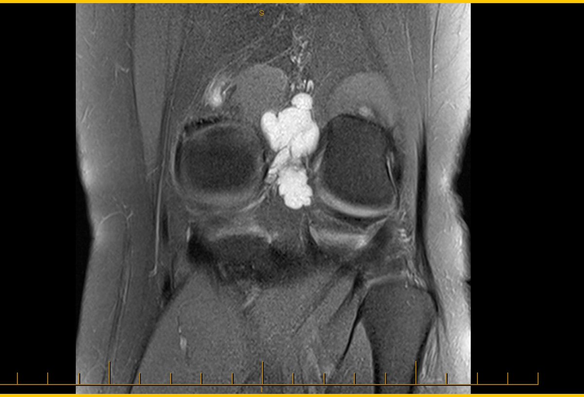 ponderaphysio's tweet photo. MRIs can be useful! Not just a Baker's cyst but a "polylubulated ganglion encompassing the semimembranosous tendon..we wondered why we were having trouble figuring this one out. Hyperextension injury 10 years ago &amp; no other symptoms until now. #physio #choosewisley #orthopeadics https://t.co/zIwZXfKuWc