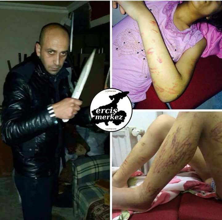 vatan4millet's tweet photo. 13 yaşındaki küçücük bir kız, uyuşturucu bağımlısı babası tarafından 5 buçuk saat boyunca işkenceye maruz bırakılmış sigara yedirilmis ıslatılmış, ve bu süre içerisinde demir çubuklarla defalarca darp edilmisti.

Simdi #kadıncınayetleri @ailebakanligi  @aysenurislam https://t.co/lnY8DbW9bu