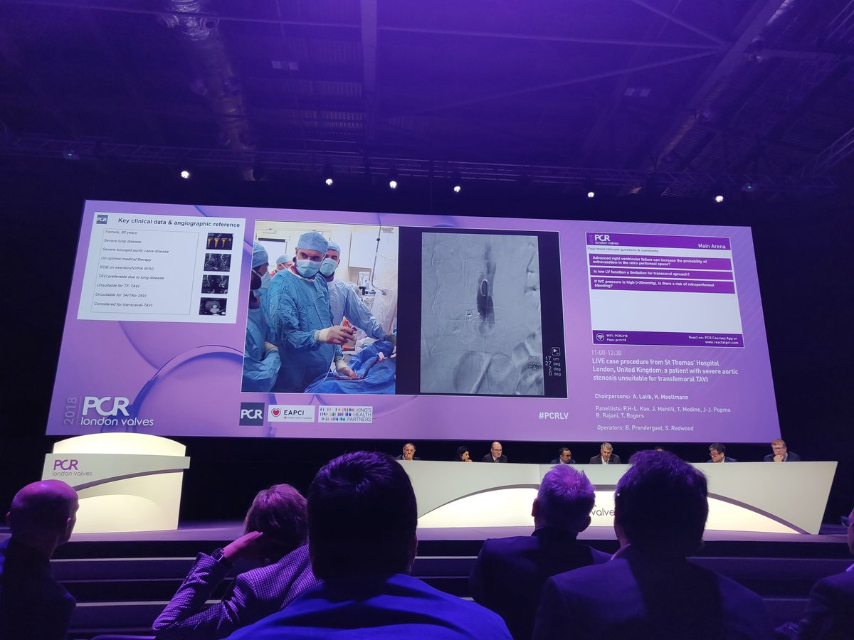 BrHeartValveSoc's tweet image. Not suitable for transferral #TAVI? No problem - stylish #transcaval beautifully demonstrated by the St Thomas' team - an ideal first choice alternative access? @PCRonline #PCRLV