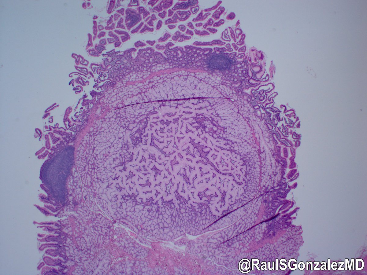 RaulSGonzalezMD's tweet image. As reported at this year's USCAP meeting, Brunner glands in the duodenum can undergo papillary and IPMN-like changes. This section doesn't do a great job showing off the papillary architecture, but man, it looks neat! #pathology #gipath