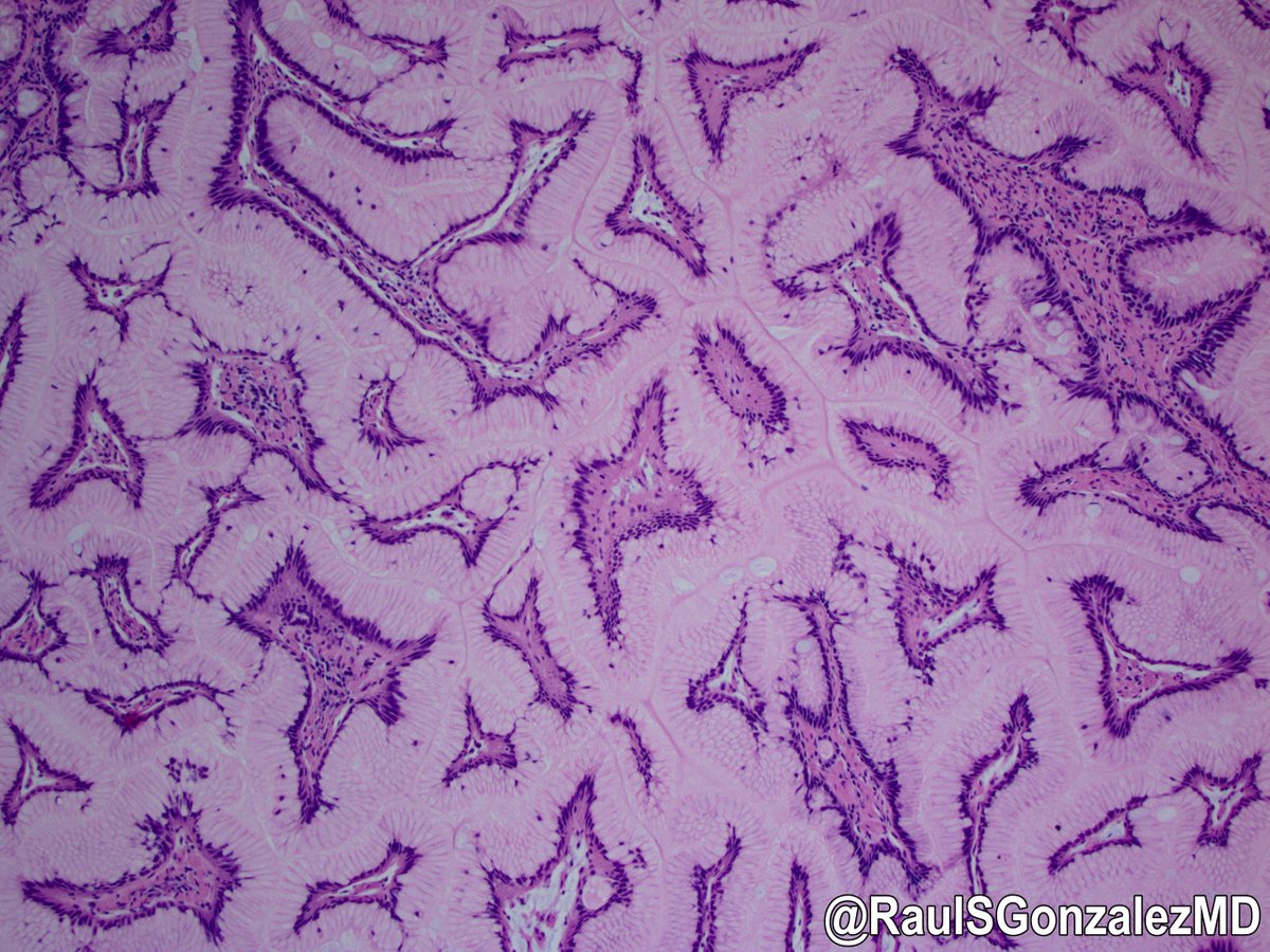 RaulSGonzalezMD's tweet image. As reported at this year's USCAP meeting, Brunner glands in the duodenum can undergo papillary and IPMN-like changes. This section doesn't do a great job showing off the papillary architecture, but man, it looks neat! #pathology #gipath