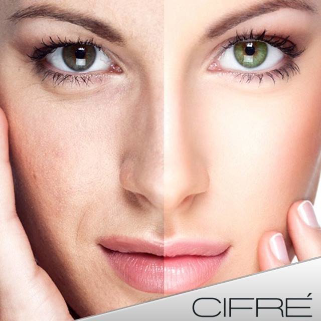 ¡Dile Adiós a las machas, con nuestra mesoterapia facial . Llámanos al 809 535-2759. #Estetica #medicina #belleza #mesoterapia