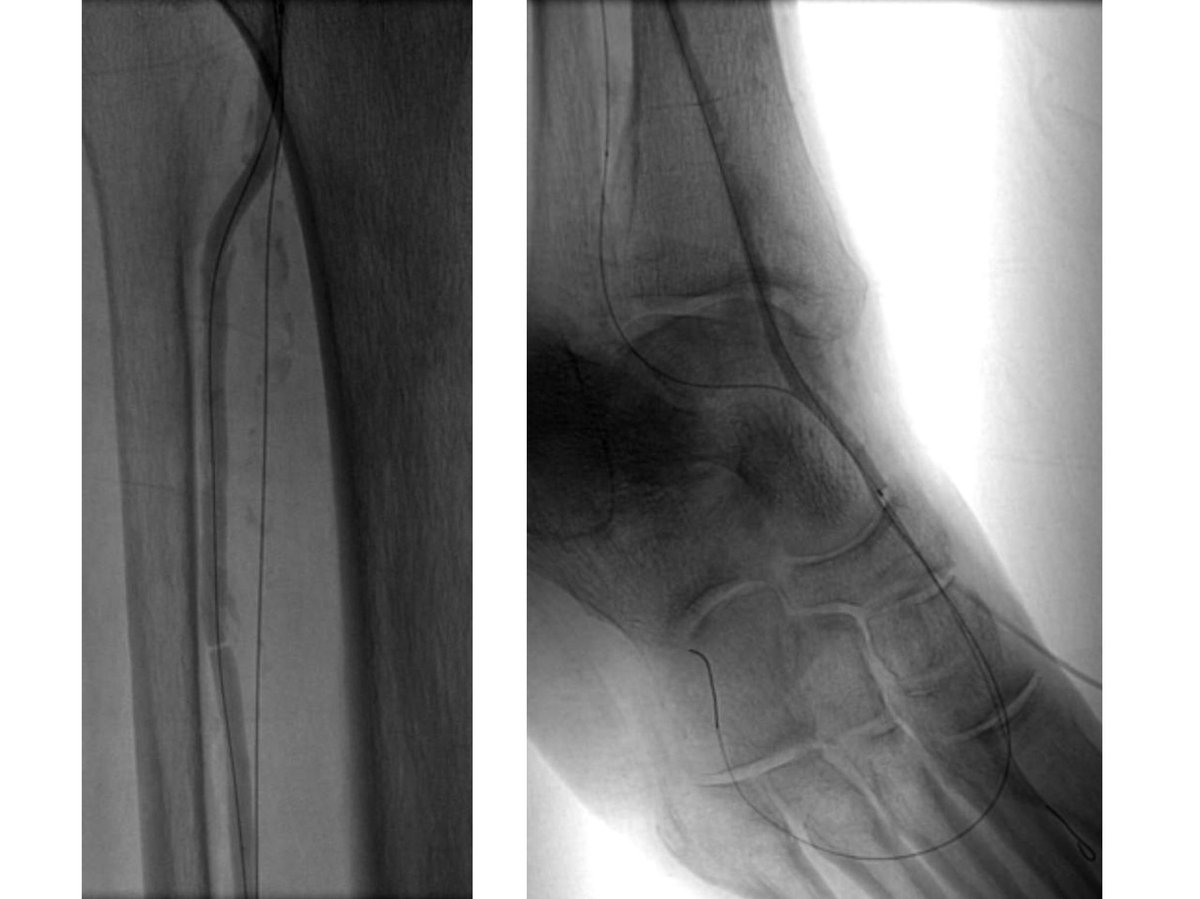 AlexCVIR's tweet image. 82 yo F with R5 ulcers of 3rd &amp;amp; 4th toes. #IRad can help with infrapopliteal and pedal revascularization to #StopTheChop. #mylegmylife #CLIFighters @SIRspecialists @SIRRFS @CLI_Global @AMPSymposium @pj_rochon