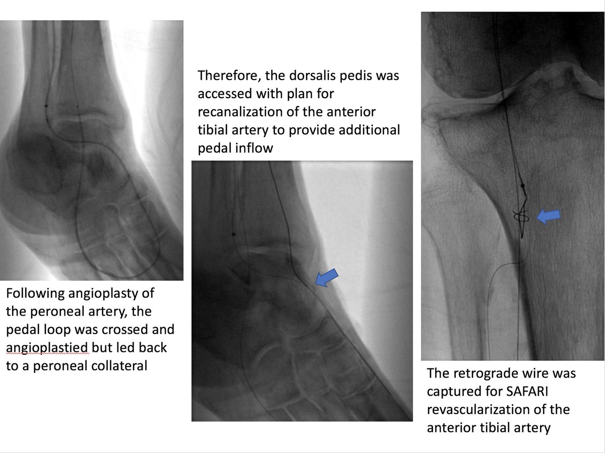AlexCVIR's tweet image. 82 yo F with R5 ulcers of 3rd &amp;amp; 4th toes. #IRad can help with infrapopliteal and pedal revascularization to #StopTheChop. #mylegmylife #CLIFighters @SIRspecialists @SIRRFS @CLI_Global @AMPSymposium @pj_rochon