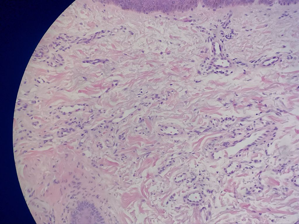 DermpathMGH (@dermpathmgh) on Twitter photo Broad band/plaque-like proliferation of capillary vessel in the superficial dermis arranged parallel to the surface, often in a setting of solar elastosis: Acquired elastotic hemangioma #Dermpath365 #Dermpath <a href="/DrPatrickRush/">Patrick Rush</a> <a href="/JMGardnerMD/">Jerad Gardner, MD</a> <a href="/RosNazarianMD/">Rosalynn Nazarian MD</a> <a href="/LynDuncanMD/">LMD</a> Broad band/plaque-like proliferation of capillary vessel in the superficial dermis arranged parallel to the surface, often in a setting of solar elastosis: Acquired elastotic hemangioma #Dermpath365 #Dermpath <a href="/DrPatrickRush/">Patrick Rush</a> <a href="/JMGardnerMD/">Jerad Gardner, MD</a> <a href="/RosNazarianMD/">Rosalynn Nazarian MD</a> <a href="/LynDuncanMD/">LMD</a>