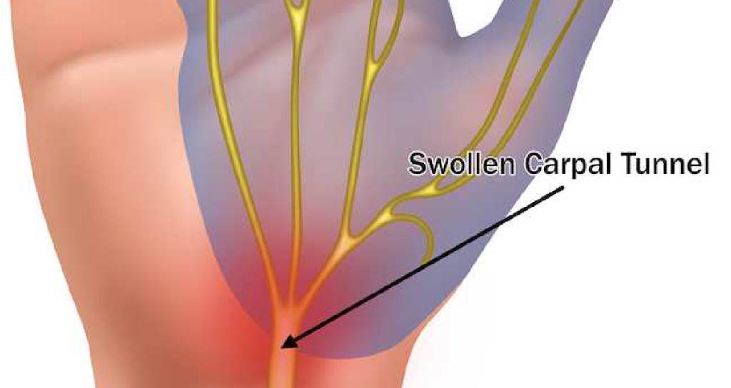 WebMD's tweet image. Carpal tunnel syndrome develops slowly. At first, you're most likely to notice it at night or when you first wake up in the morning. The feeling is similar to the "pins-and-needles" sensation you get when your hand falls asleep. More information: wb.md/2MhvMVv