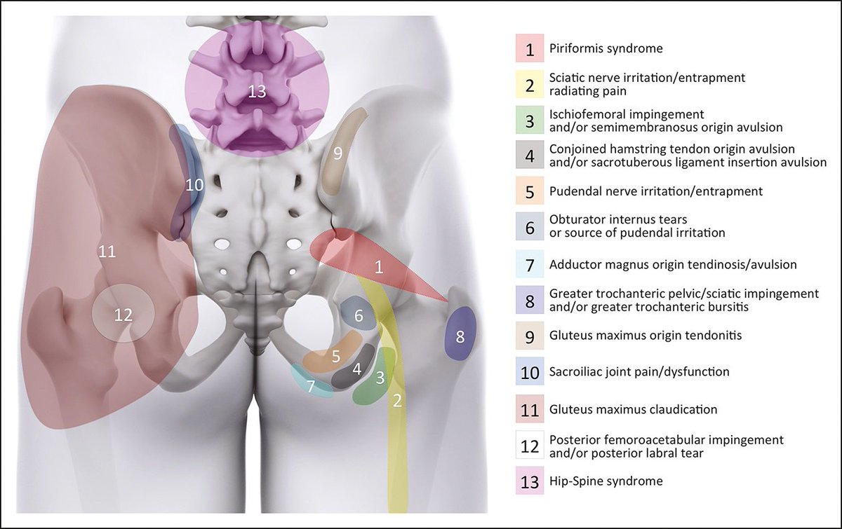 Hip Pain Location Diagram - Derslatnaback