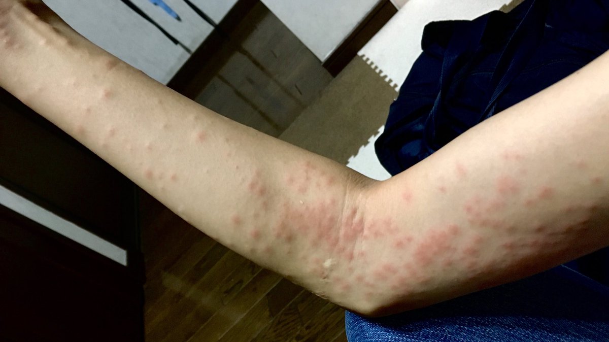 伊吹留香 11 27 金 野毛 旧バラ荘 V Twitter アレルギー性の蕁麻疹かと思いきや 毛虫皮膚炎とのこと 最近毛虫なんか触れるどころか見た憶えすらない としても 風に舞った毒針毛が肌に付くだけでこうなりえるのだと知って 納得 全身に広がり 何にも集中できない