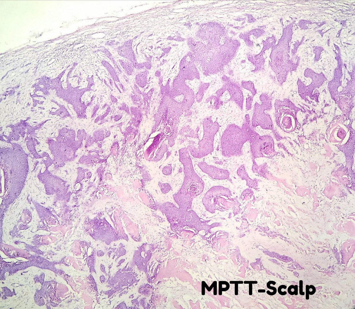 DrNishatAfroz2's tweet photo. 60YM, ulcerated nodular Scalp mass.Malignant Proliferating Trichilemmal tumor. Tumor cells were CD 34+n Ki 67 was 20-25%.#Pathology #HumanPathology, #Histopathology
#DiagnosticPathology https://t.co/IdtCQqYb8r