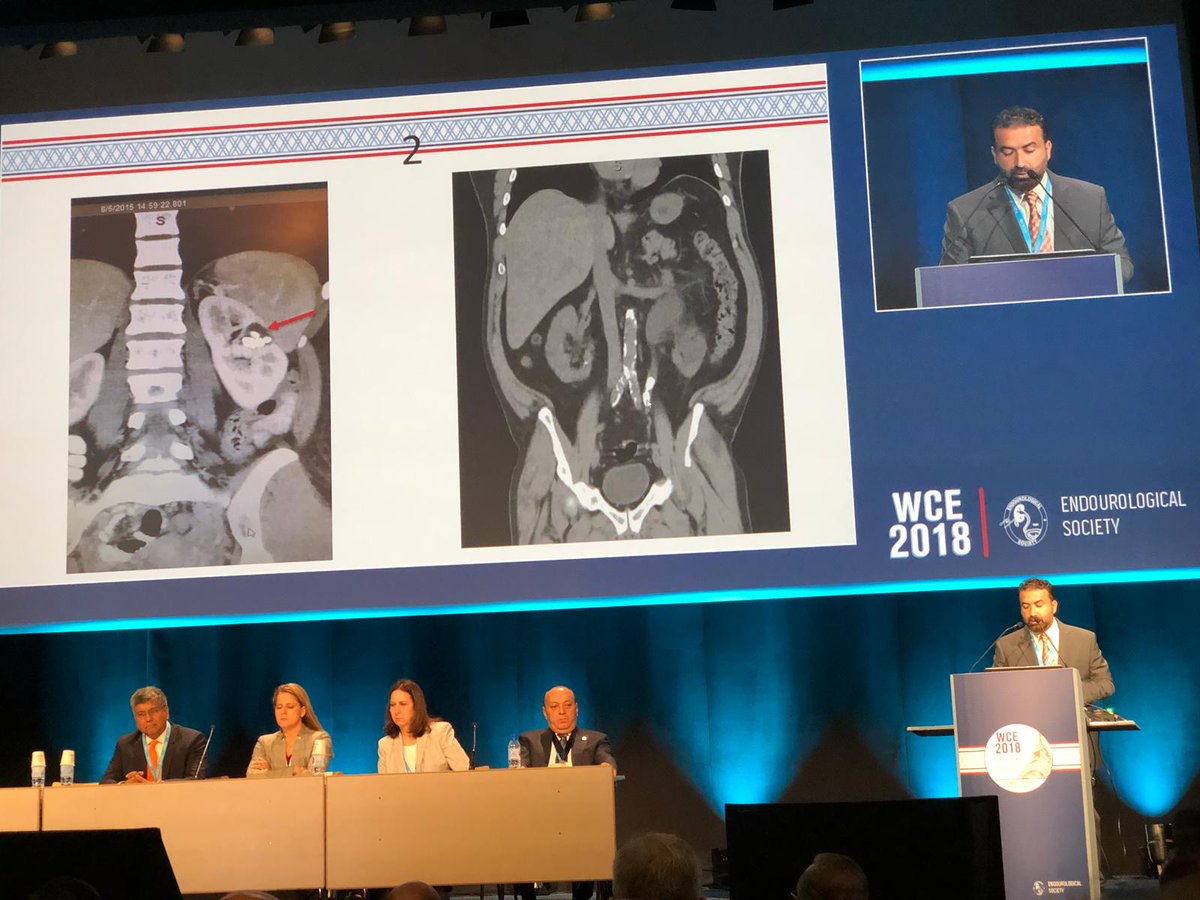 Robodoc38's tweet photo. Robotic Surgery for managing kidney stones? Yes #WCE2018 #wce18 https://t.co/BGb0Keurxy