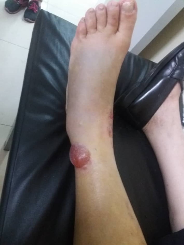 Abraham20627768's tweet photo. @PublServ @FLaPastillita @spvzla  Buenas noches, busco en CARACAS 4 donantes de sangre  #URGENTE de cualquier tipo Contactar Abraham Rivas 0412-603-3874 indispensables para intervensión quirúrgica a causa de tres fracturas en el pie y tobillo izquierdo de mi madre #caracas #Sucre https://t.co/41zXyskLqg