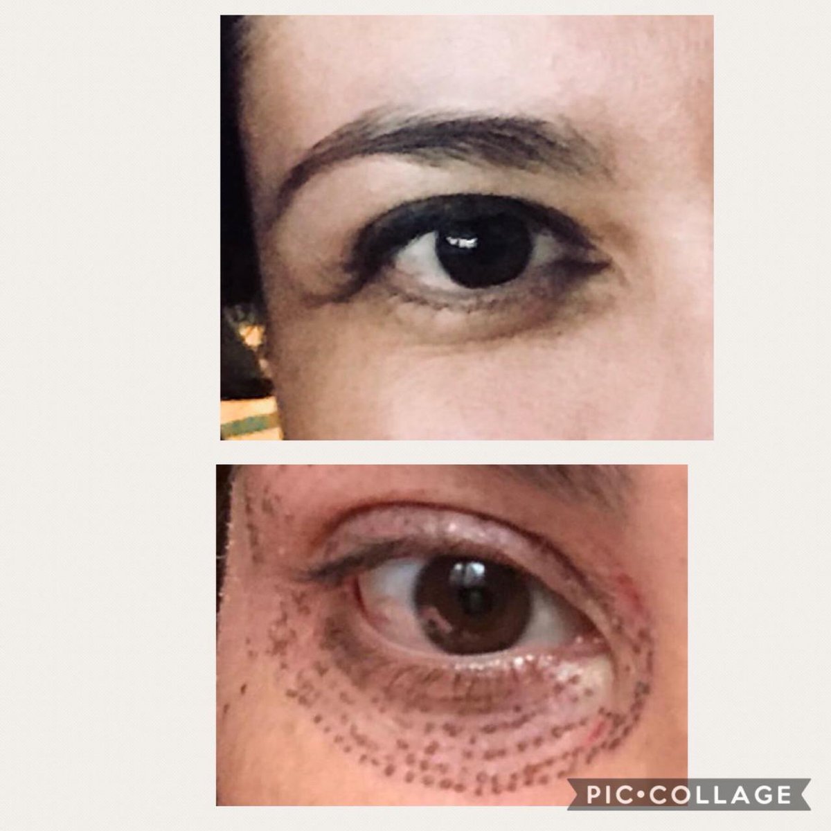 Hispali's tweet photo. Tan solo tres DÍAS de haberse hecho #Plasmage el original no imitaciones!!! Vean la retracción de la flacidez del párpado superior!!! https://t.co/rN93f6EzQ2