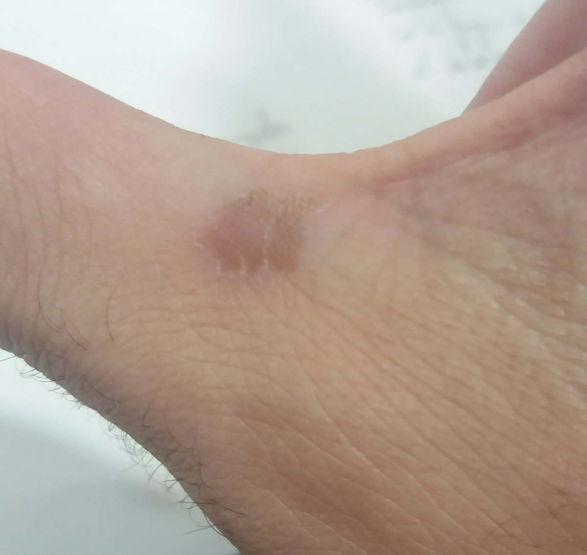 MisterJagger_'s tweet photo. Me hice dos heridas exactamente iguales en la base del pulgar de cada mano y probé a desinfectarme una sí y otra no.
El resultado cuatro días después: https://t.co/Hb3aavFtM3