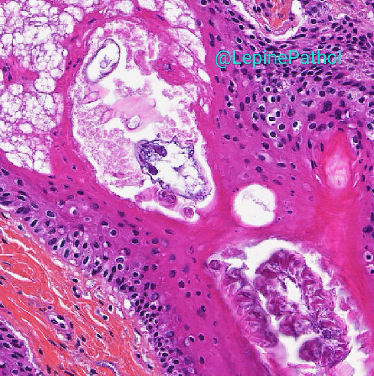 LepinePathol's tweet photo. Our Demodex buddy spotted in a nice case of rhinophyma : sebaceous gland hyperplasia, follicular plugging with  Demodex, dilatation and enlargment of pilosebaceous structures, folliculitis. Case viewed with @CecileBadoualMD #ENTpathology #DermPath #Nose #Rhinophyma #pathology https://t.co/eBD4RwbyER
