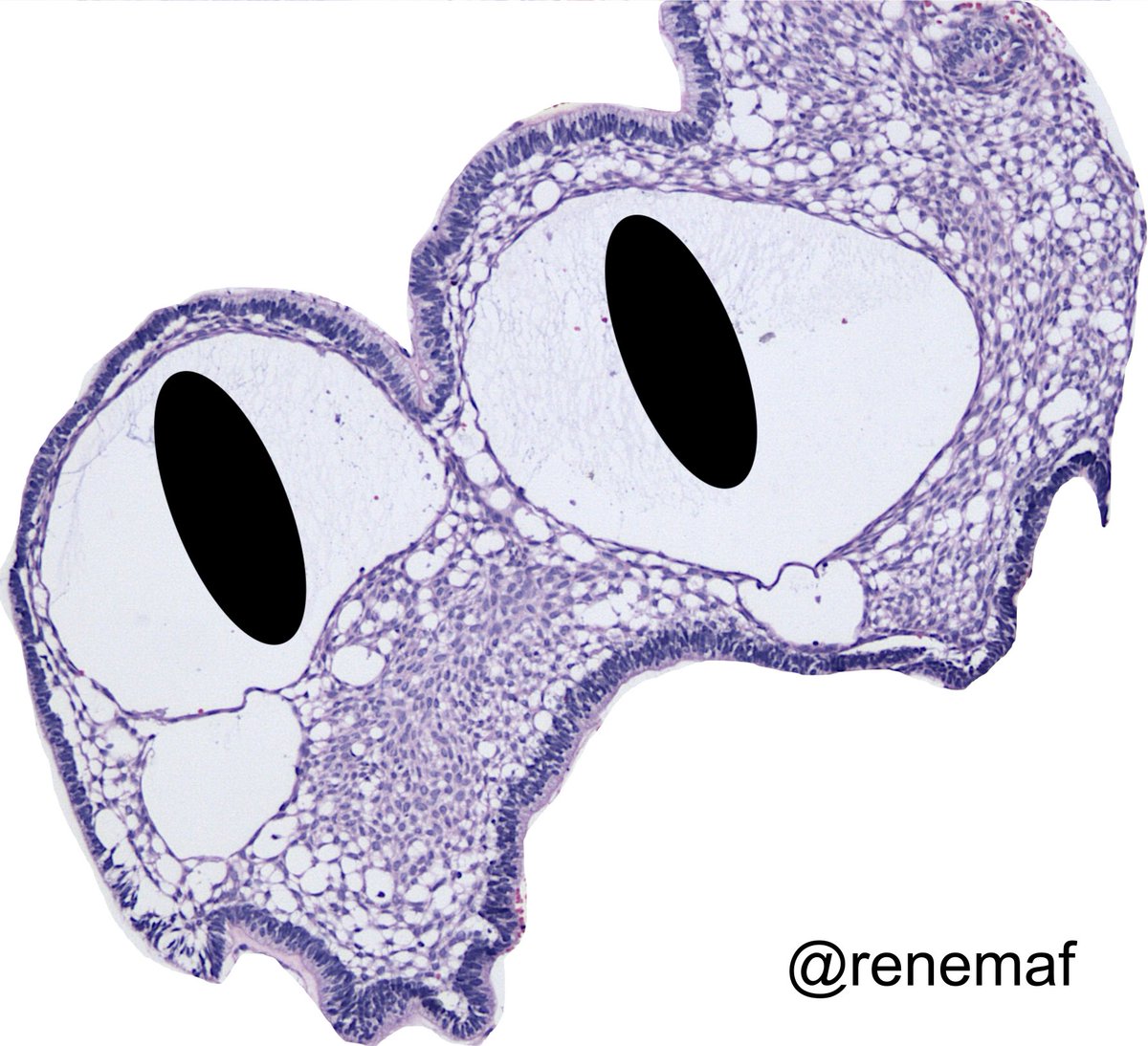 Have a great week 💪🏻! Ameloblastomatous snake 🐍 #odontogenictumors #oralpathology #oralpath #pathart