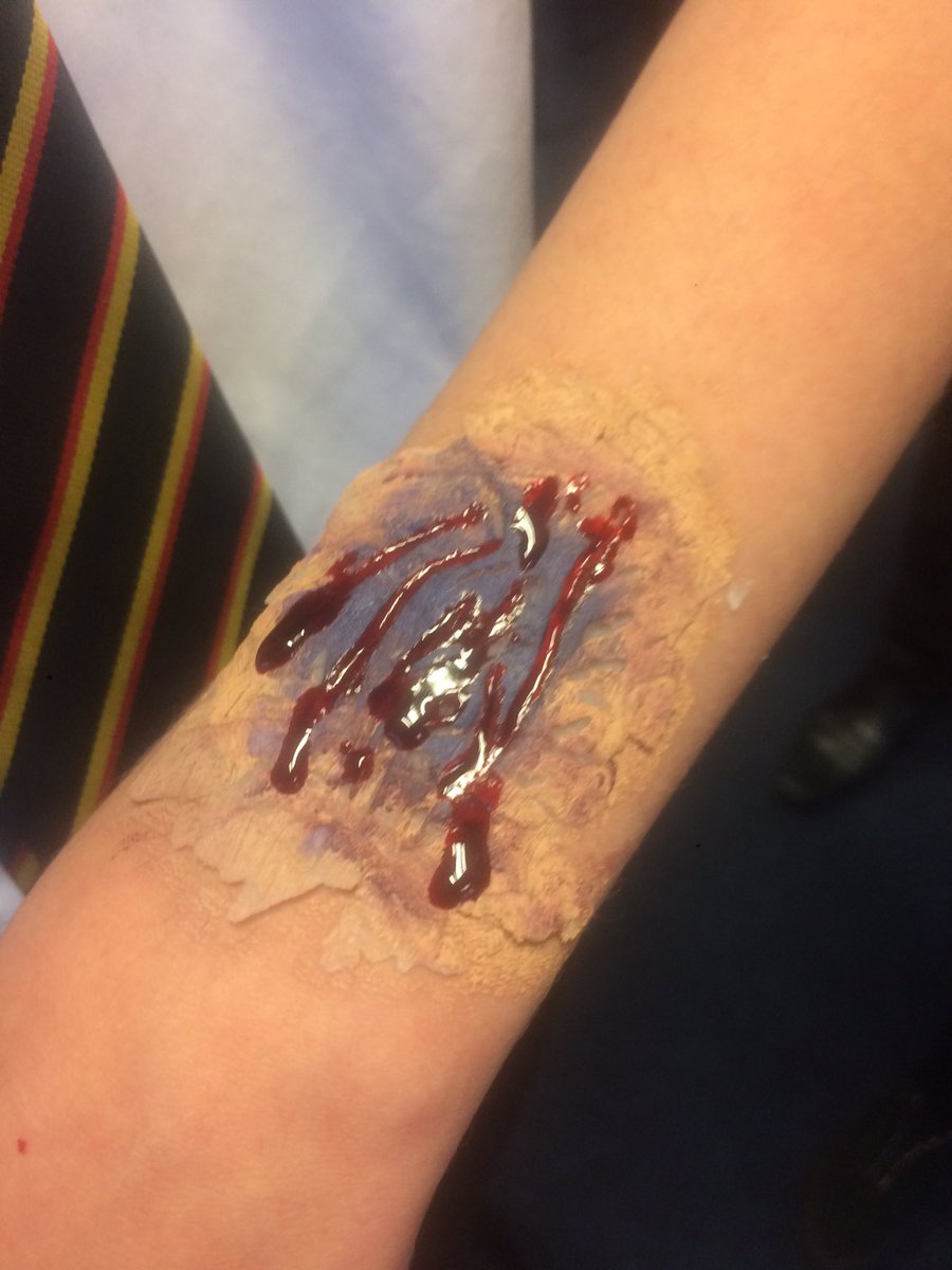 S2 Drama Elective have been exploring 'scar wax' in today's lesson. It is a hard material to work with and they done a fantastic job in creating an open wound/cut effect! Well done! #specialeffects #scarwax #theatremakeup #makeupskills @baexpressiveart @Boness_Academy