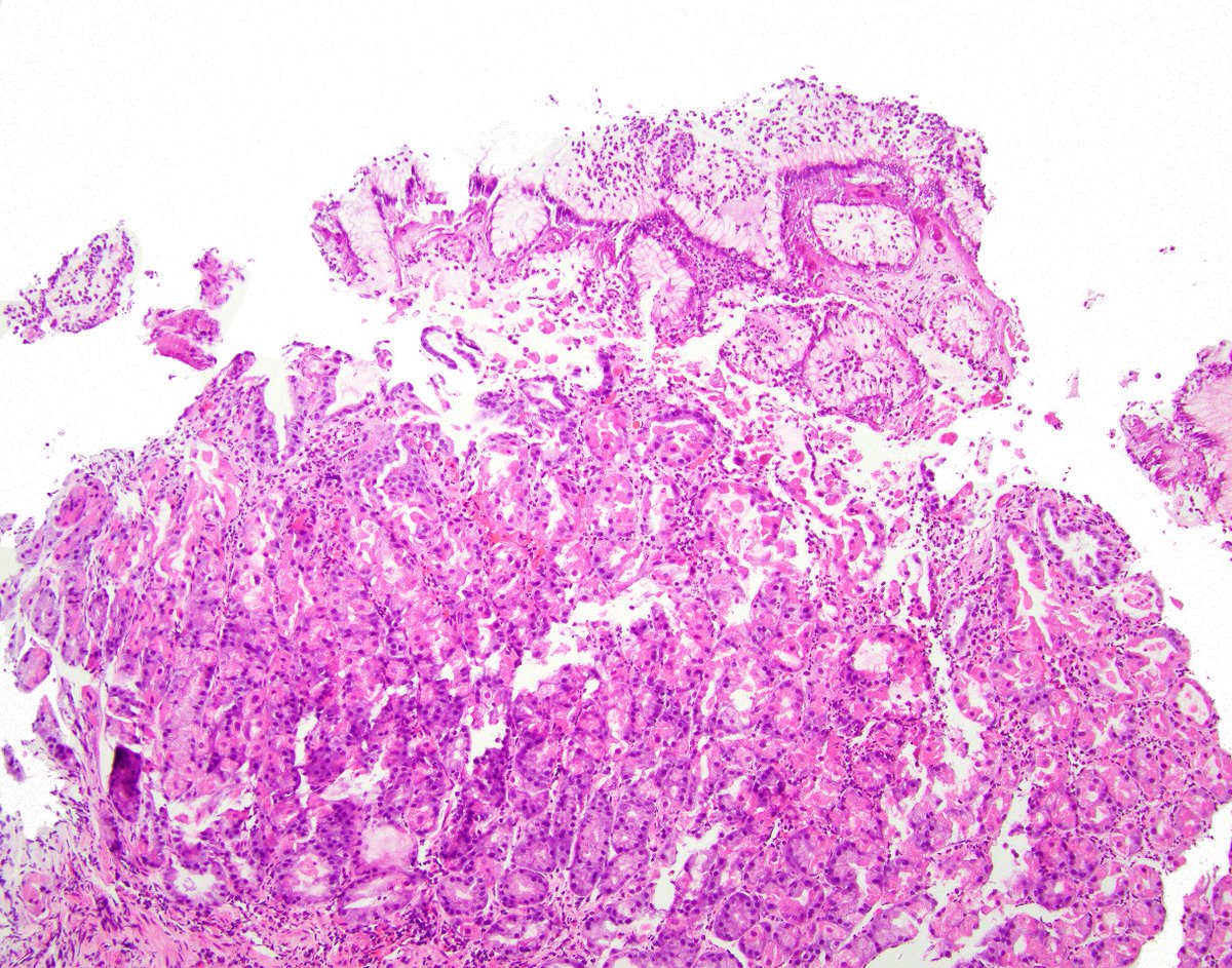 LizMontgomeryMD's tweet photo. Yummy case of doxycycline gastropathy.  Check out the fibrinoid change in the tiny vessels that are pointed out with arrows.  I was just proud to be able to draw arrows in photoshop. https://t.co/003bfMYP4K
