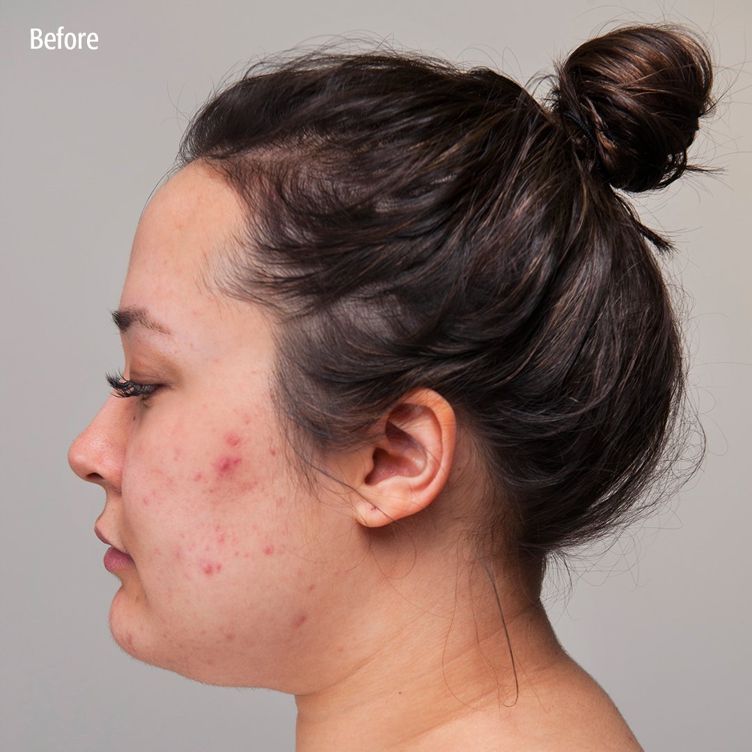 eminence acne advanced treatment system