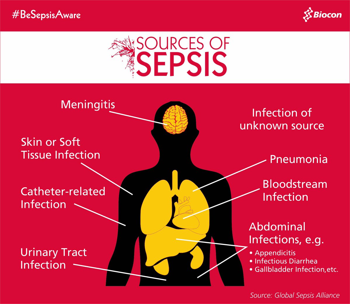 BioconMalaysia's tweet photo. #DidYouKnow? Sepsis is a common pathway to death from most infectious diseases worldwide. Here are the most common sources of sepsis. Itโs time to #BeSepsisAware https://t.co/Nvs5pxcBM8
