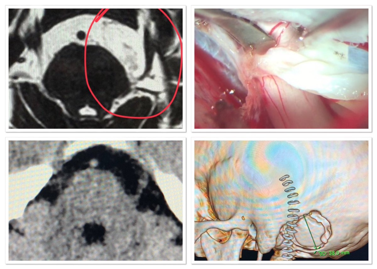 pablopenatapia's tweet image. Descompresión Microquirurgica en #NeuralgiaDelTrigemino @HospitaldelRio