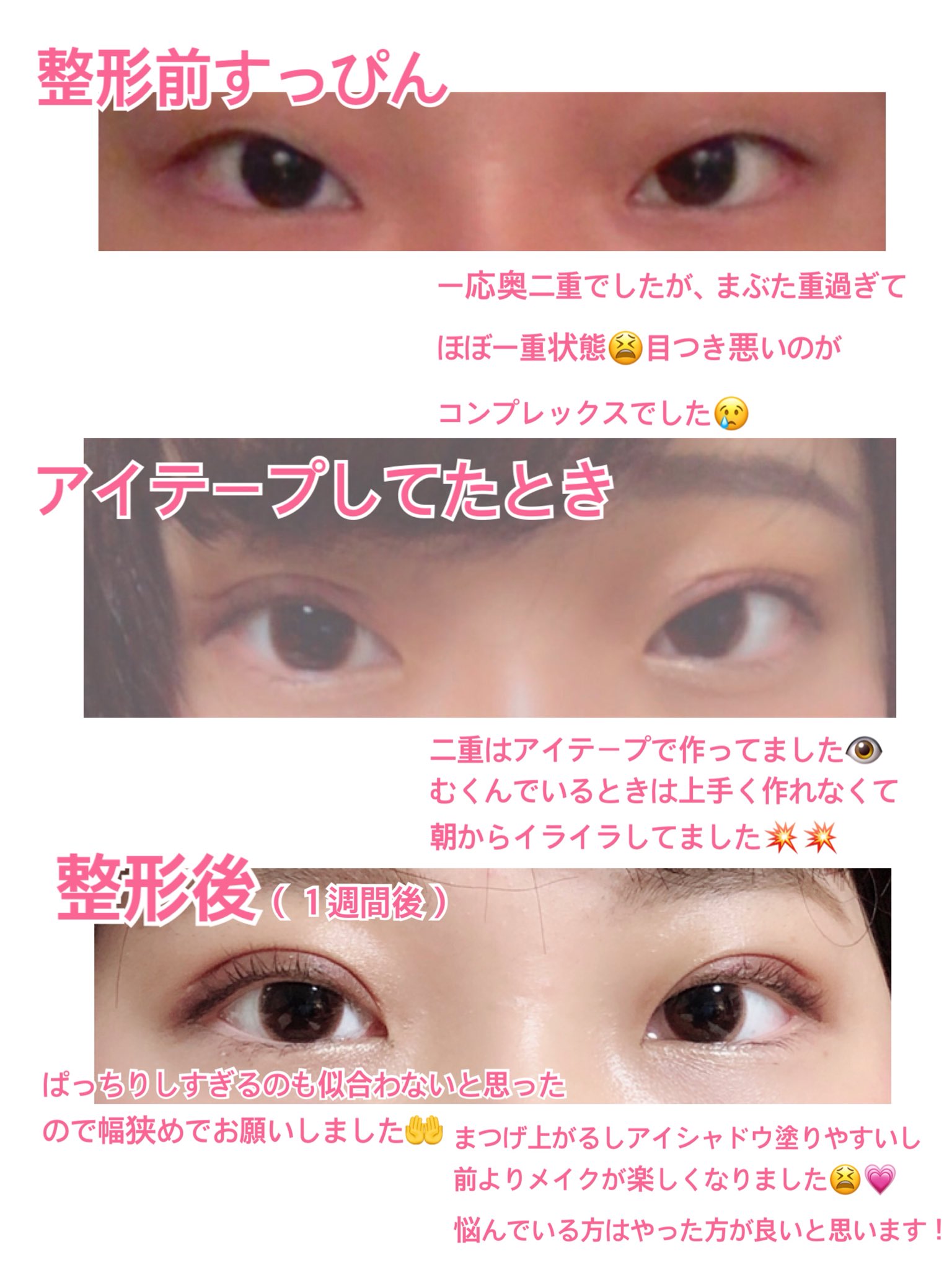 さなｦ 整形前との比較 一週間経ったので比較画像作りました 二重整形するか悩んでる人の参考になればと思います 質問等ありましたら リプordmでお答えします 二重整形 埋没 埋没経過 腫れづらいばれづらい二重術 三点留め