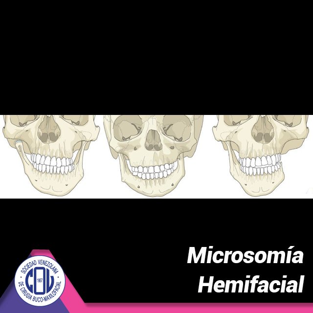 La microsomía hemifacial es un trastorno en el cual el tejido de un lado de la cara no se desarrolla completamente, lo que afecta principalmente las áreas  auditivas (oído), oral (boca) y mandibular (maxilares). Es posible que en algunos casos afecta ambos lados de la cara.